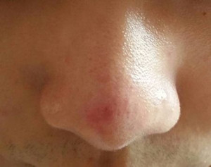 卵巢囊腫怎么形成的