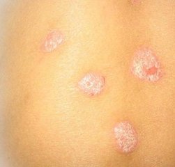 宮頸糜爛有哪些癥狀表現