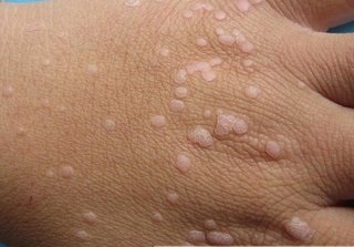 宮頸息肉早期會有什么表現