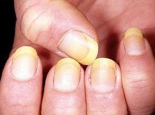 處女膜修補是怎么引起的